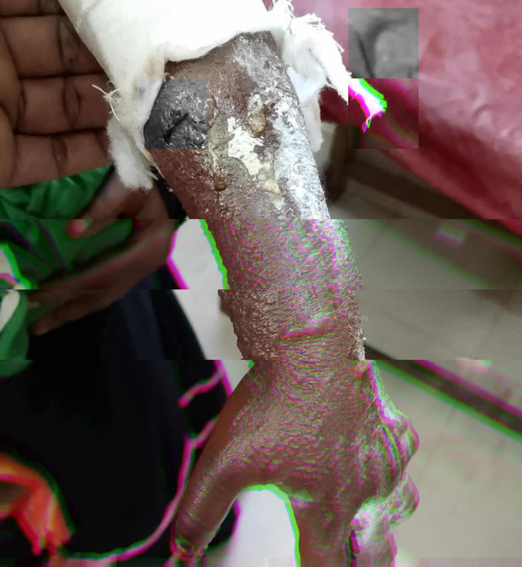 হাতুড়ে কবিরাজের চিকিৎসায় হাত হারাতে বসেছে ৪ বছরের শিশু কন্যা রুবাইদা